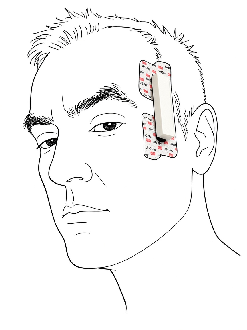 MAM Gen2 Extraoral Wearable seated on anterior temporalis with disposable pads